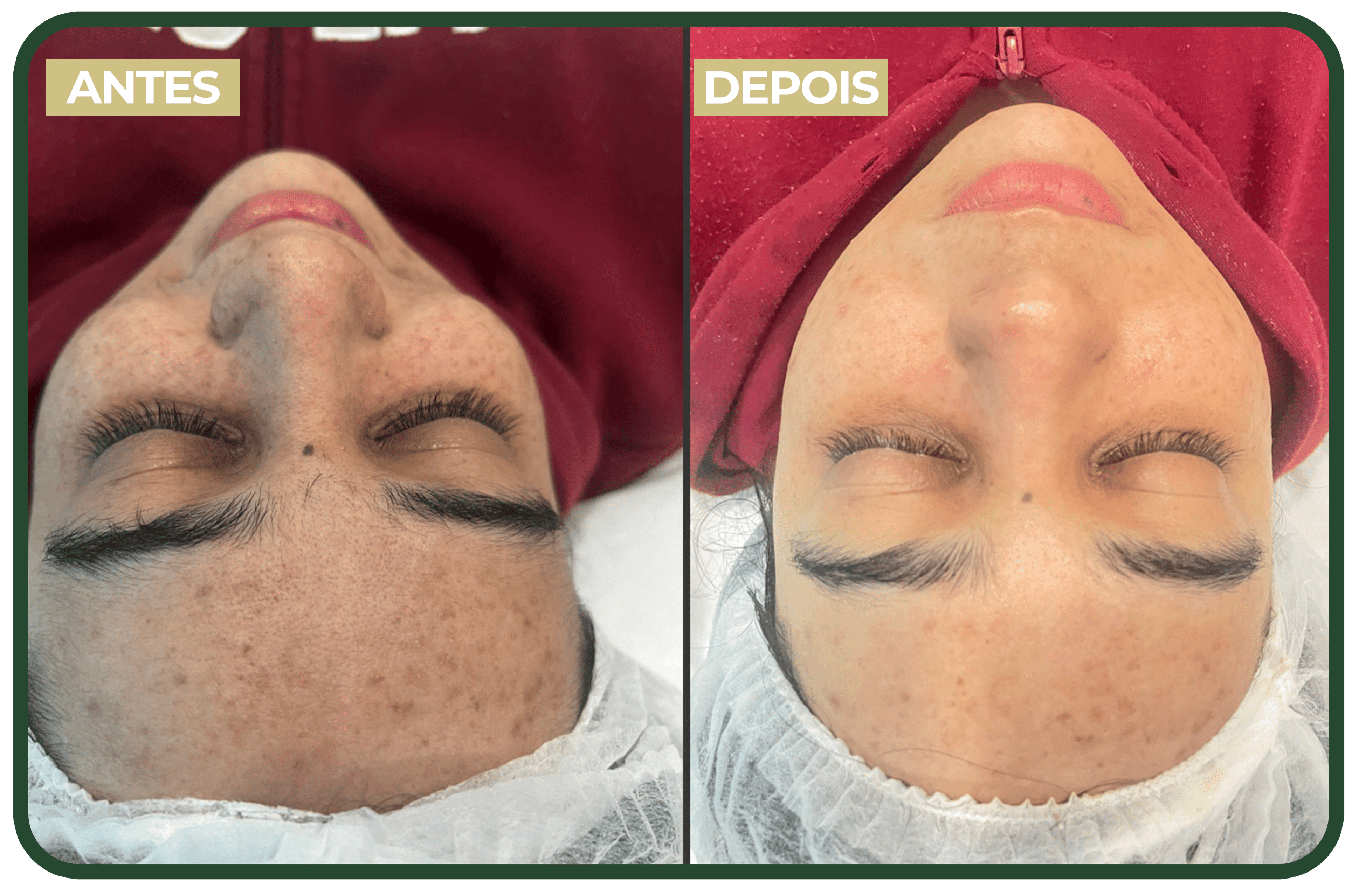 Antes e depois - Dermaplaning Facial