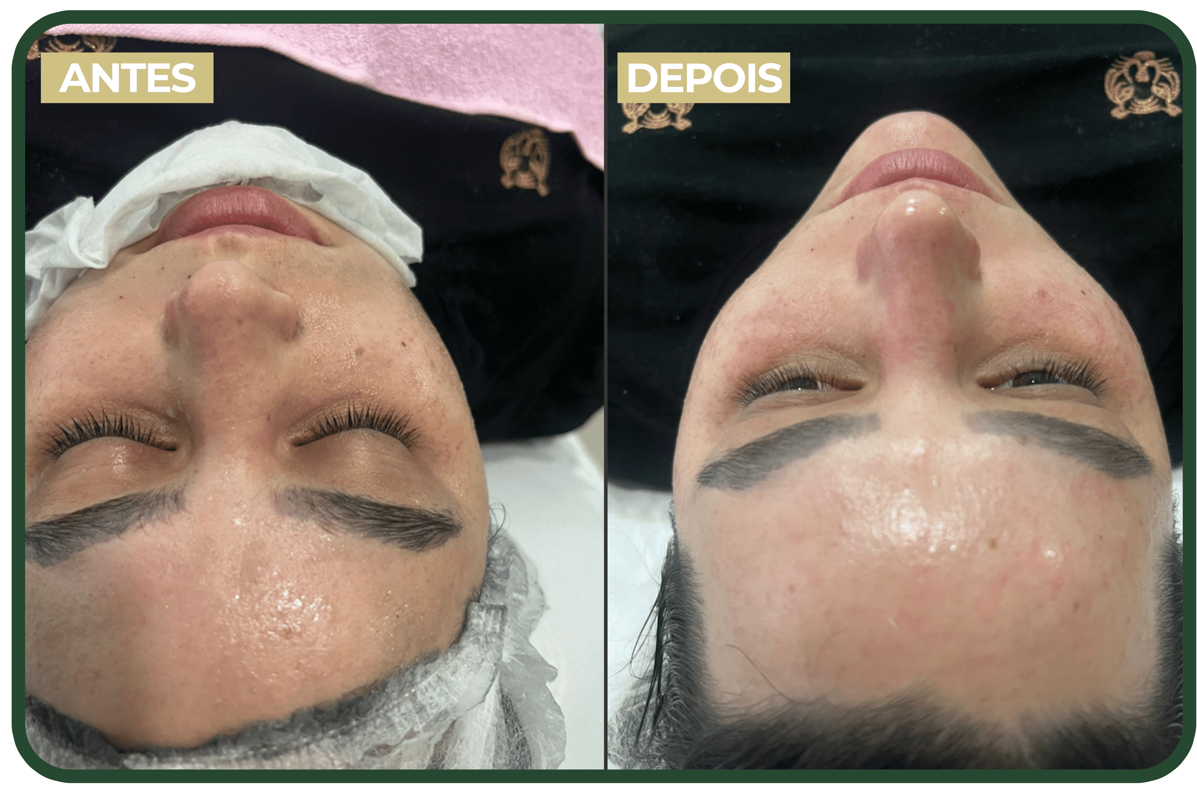 Antes e depois - Dermaplaning Facial