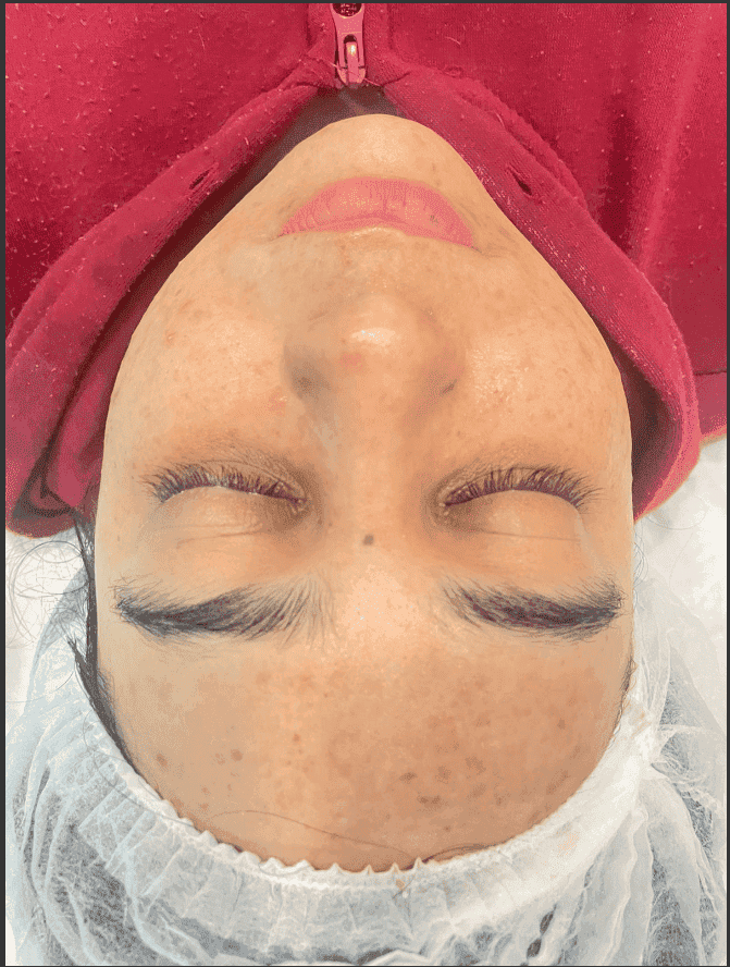 Depois do tratamento